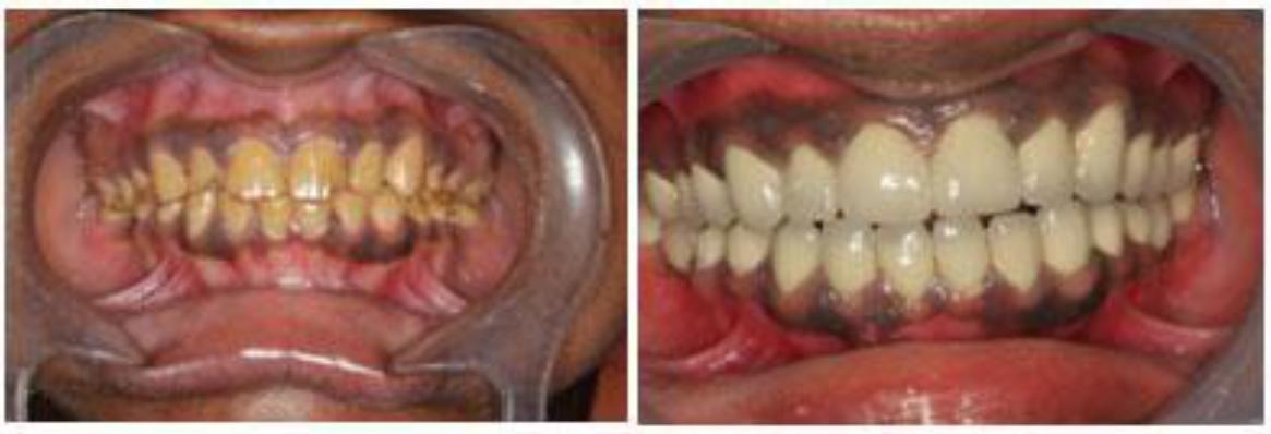 Crowns for Discoloured Teeth Case