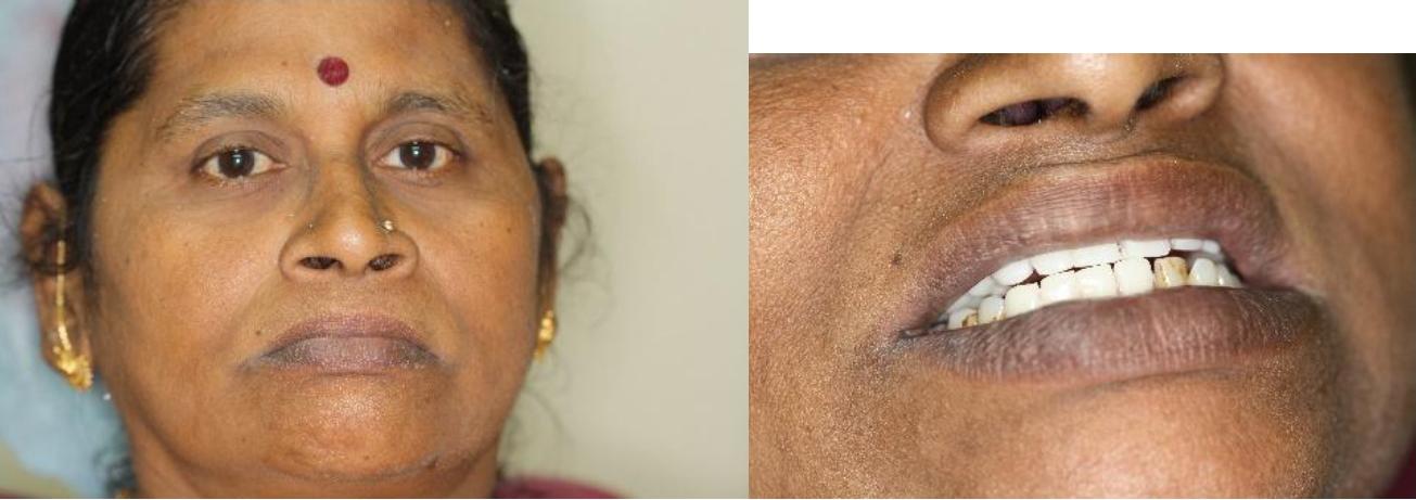 Composite Filling Case