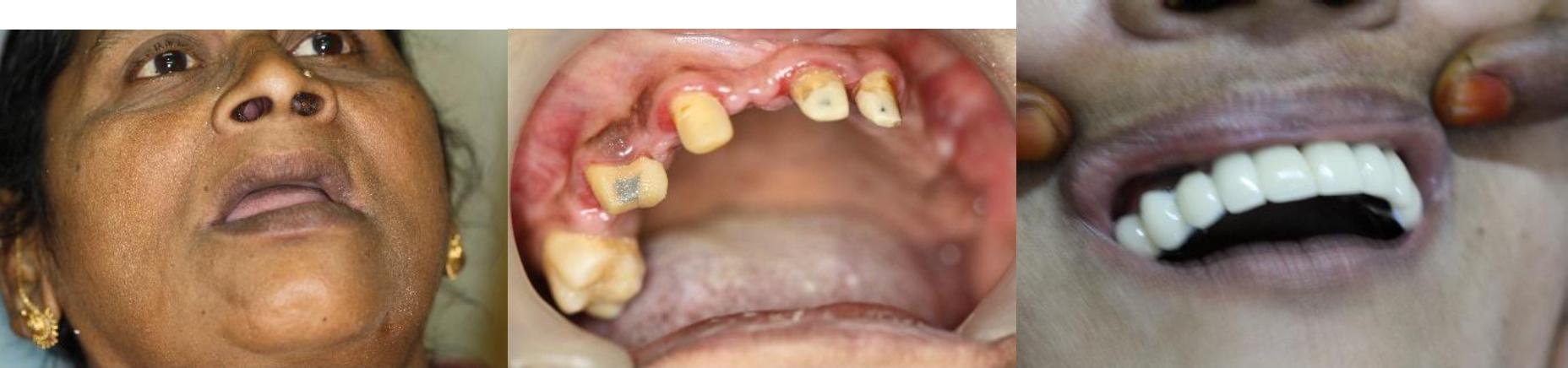 Fixed Partial Denture Bridge Case
