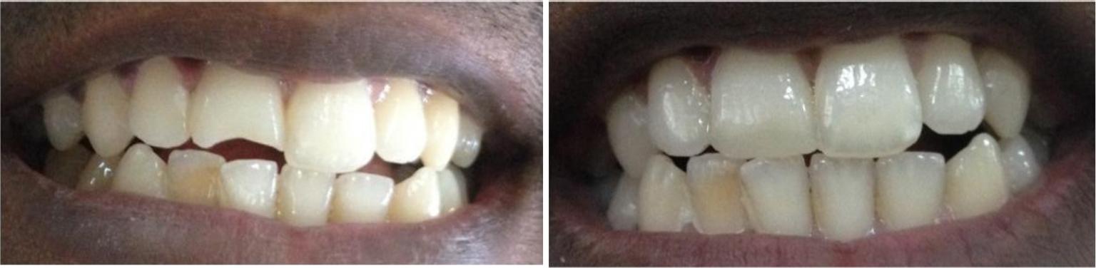 Fractured Tooth Step 1