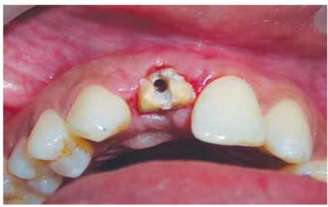 Fractured Tooth Step 2