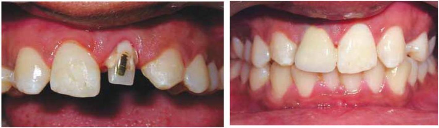 Fractured Tooth Step 3