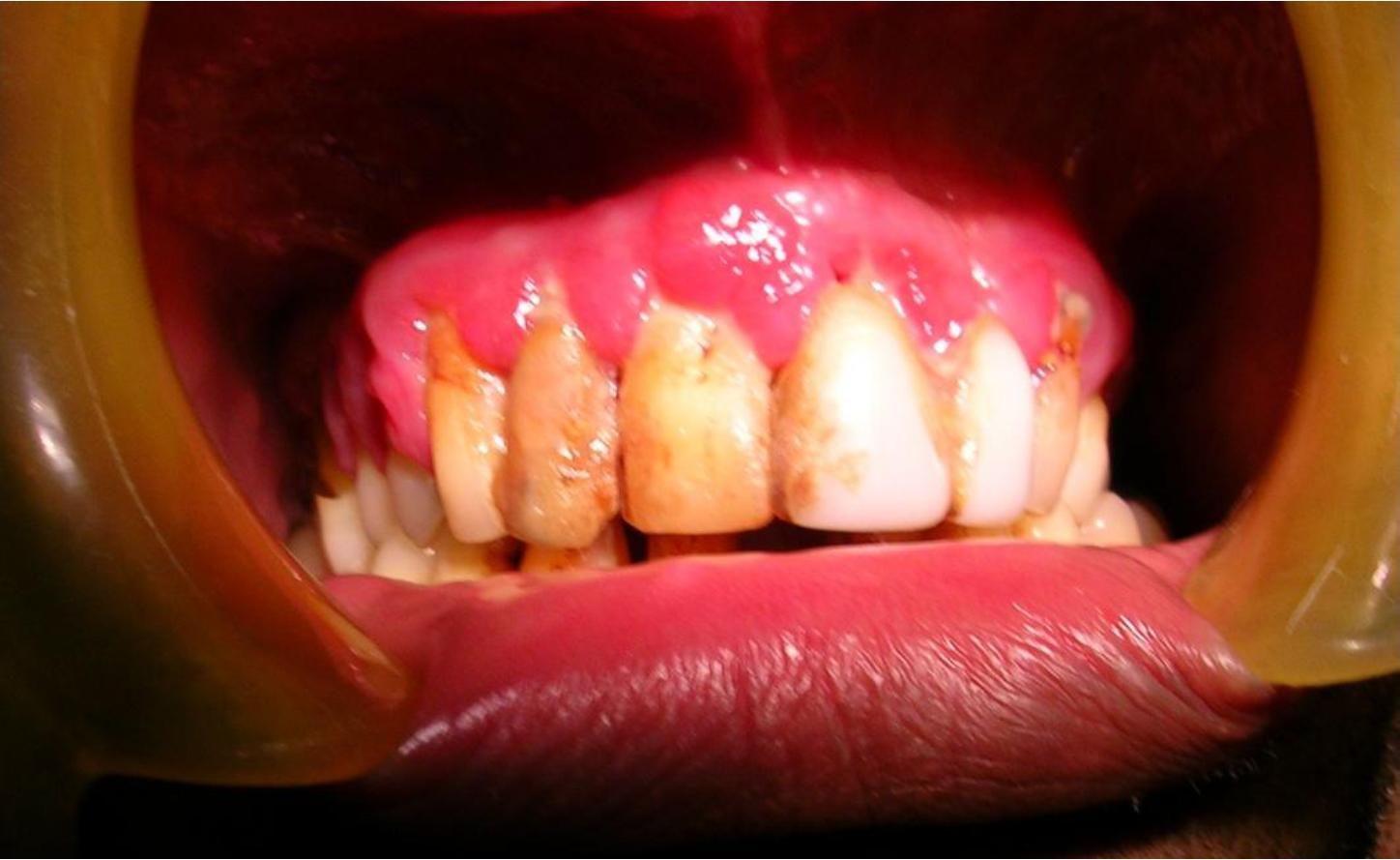 Gingival Enlargement Case