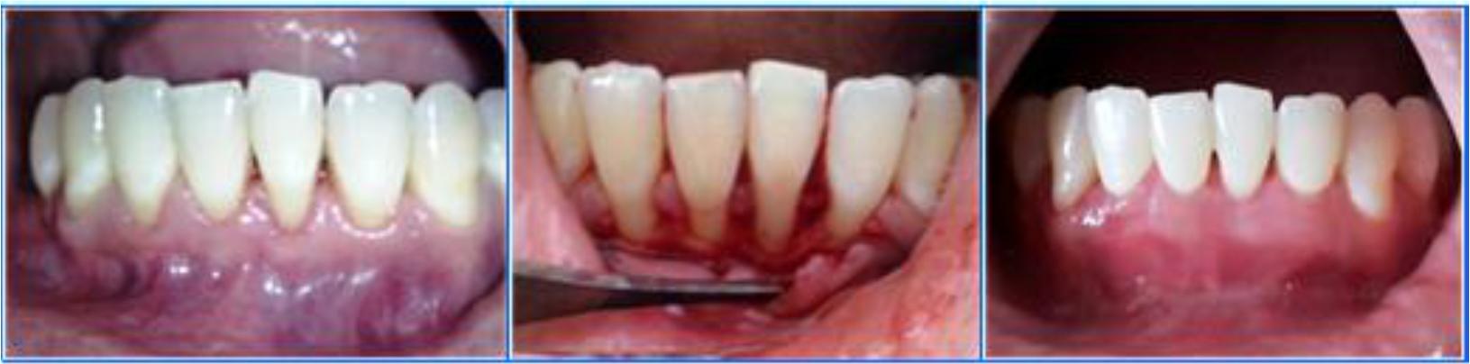 Gum Surgery Case