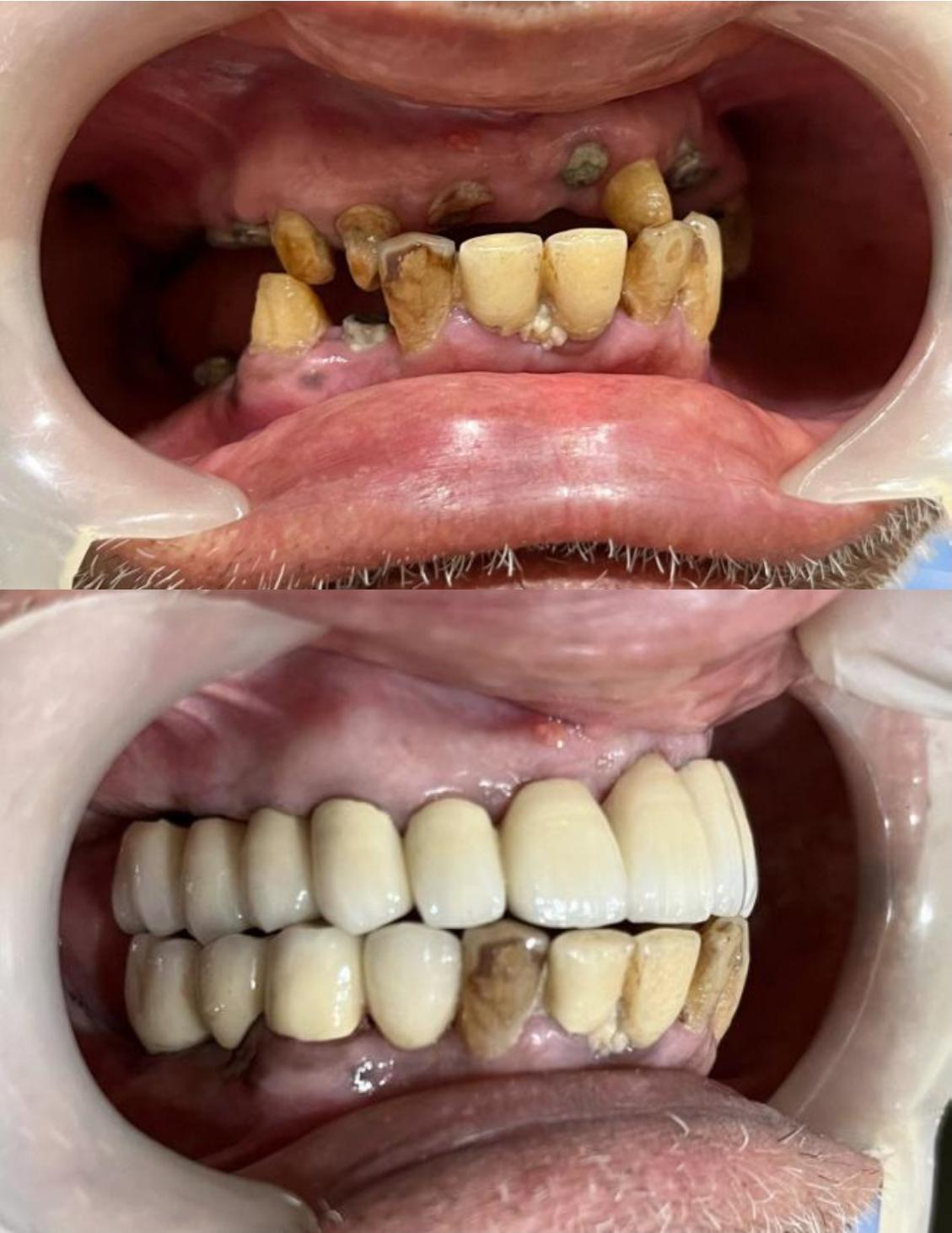Implant Supported Dentures Case