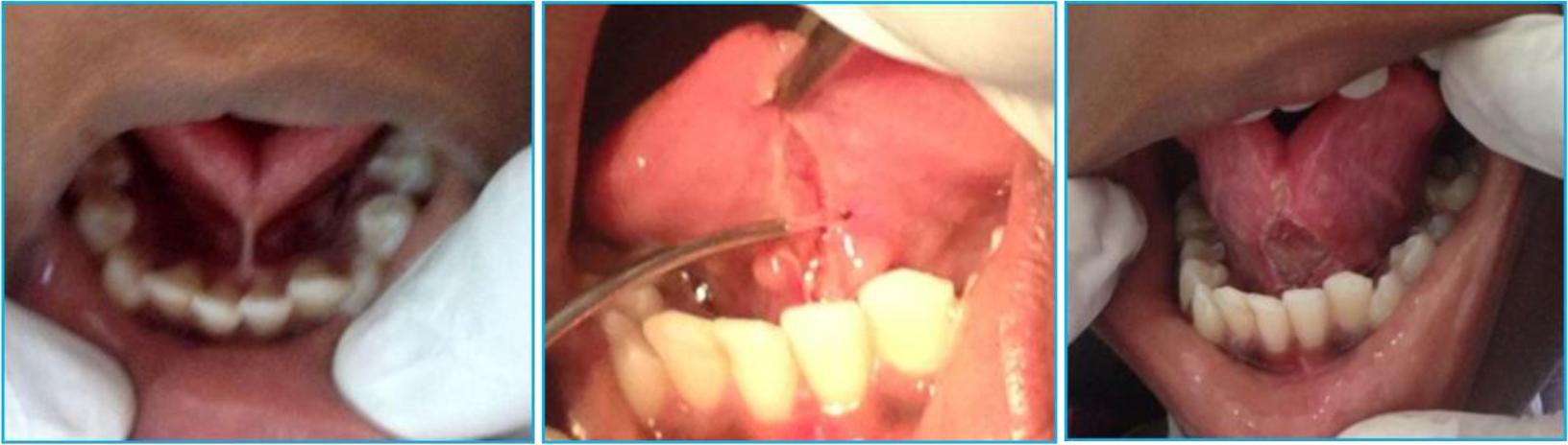 Laser Frenectomy Case