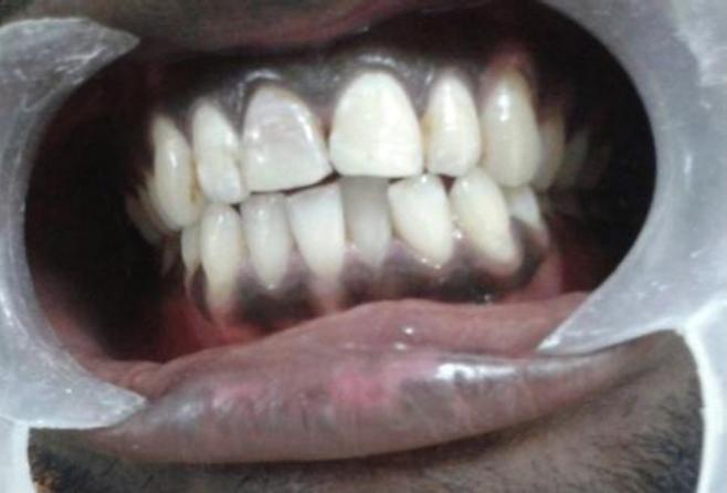 Light Cure Fillings After