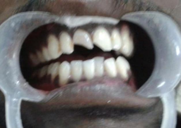 Light Cure Fillings Before