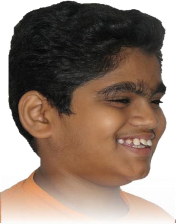 Orthodontic Case Before