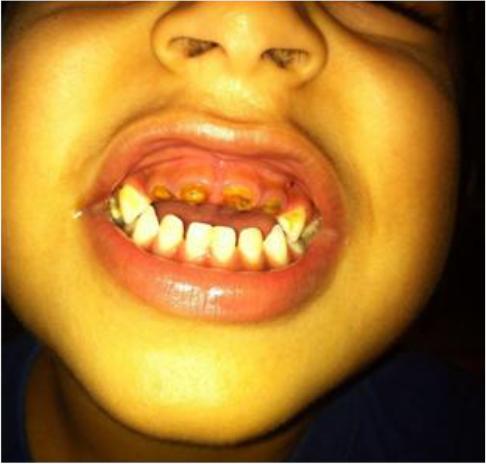 Child Caries After