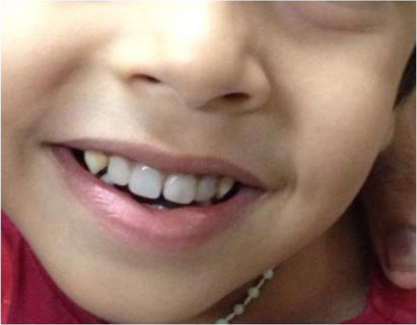 Child Caries Before